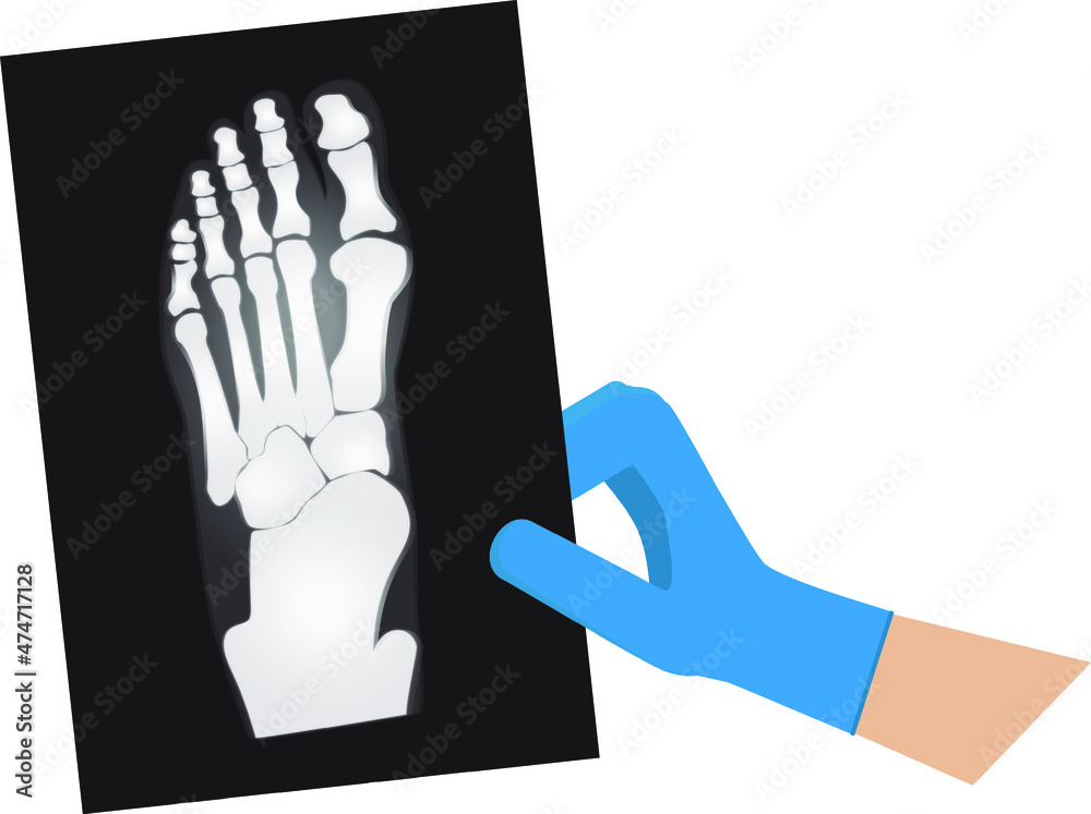 X-rays of the foot vector illustration for design Stock Vector | Adobe ...