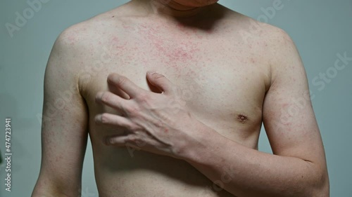 Dermatitis viral disease of young adult asian body standing scratching with itching, Red Rash, Measles Virus, Viral Exanthem photo