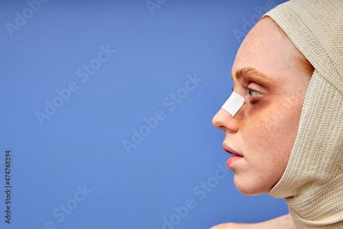 pale young caucasian woman wrapped in bandages  has postoperated bruises around eyes  had plustic surgery  removed extra fat and skin. Cosmetic surgical procedure. Removing fatty tissue. side view