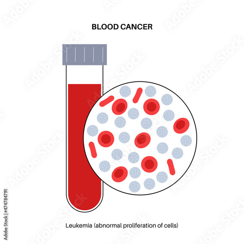 Leukemia cancer disease