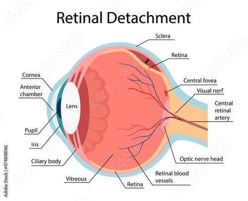 Retinal detachment vector diagram, anatomical diagram. vector cartoon style
