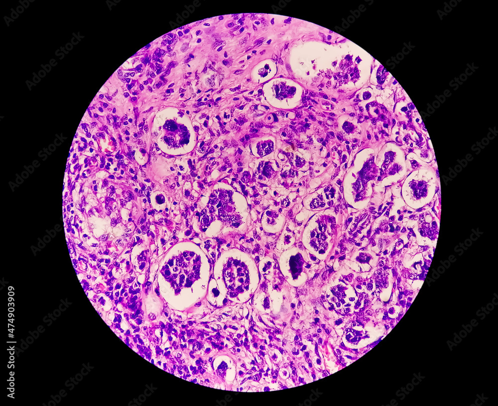 Photomicrograph of Invasive ductal carcinoma (IDC) gradeII, most