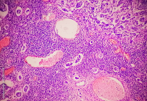 Low power photomicrograph of a breast core biopsy showing an invasive ductal carcinoma grade-II,  most common form of breast cancer. Lymphovascular invasion: Present photo