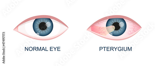 Eye healthy and with pterygium. Conjunctival degeneration before and after surgery. Eye disease. Human organ of vision with pathology. Vector realistic illustration. photo