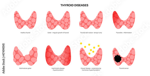 thyroid gland disease photo