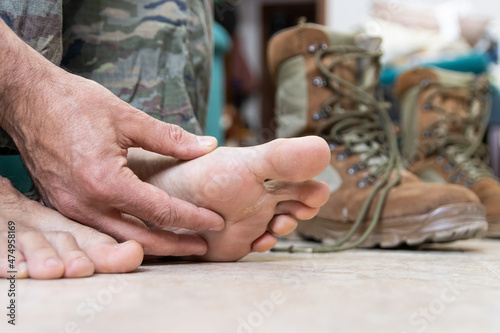 Blisters on the foot of a Caucasian military man sitting on the couch at home