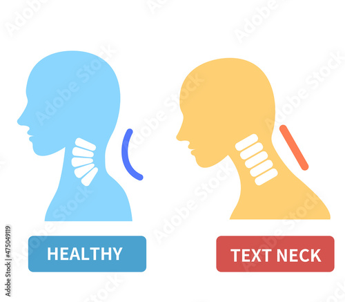 Illustration of straight neck and cervical spine.