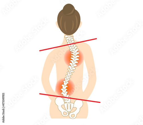 Illustration of the back of a woman with scoliosis and a bent spine.