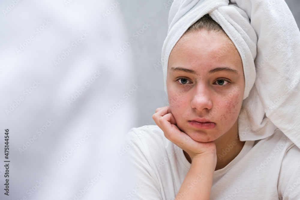 Acne. A sad teenage girl. Problematic skin in adolescents. Acne. A sad teenage girl. Problematic skin in adolescents.