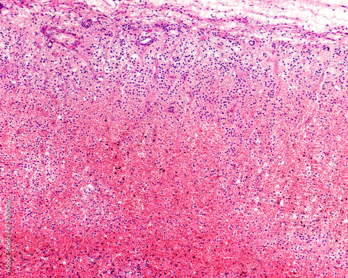 Human adrenal cortex. Waterhouse-Friderichsen syndrome photo