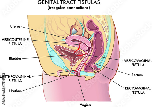 Medical illustration of the irregular connections called fistulas that can be found in the woman's genital tract. photo