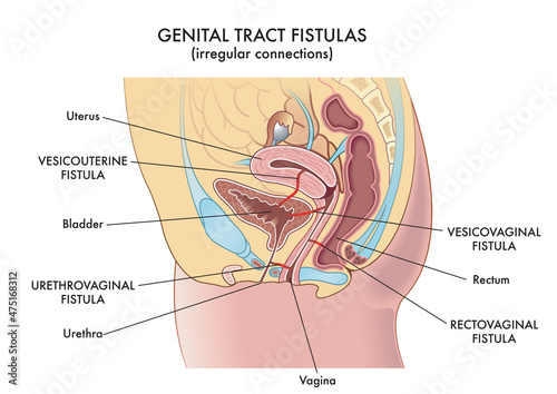 Medical illustration of the irregular connections called fistulas that can be found in the woman's genital tract. photo
