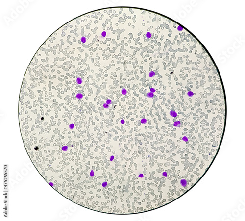 Leuco-erythroblastic anaemia and Chronic myelomonocytic leukemia (CMML), MPD, Blood smear under microscope photo