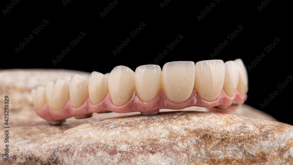 Dental implants and dentures in close-up Siemke on a black background
Dental implants and dentures in close-up Siemke on a black background