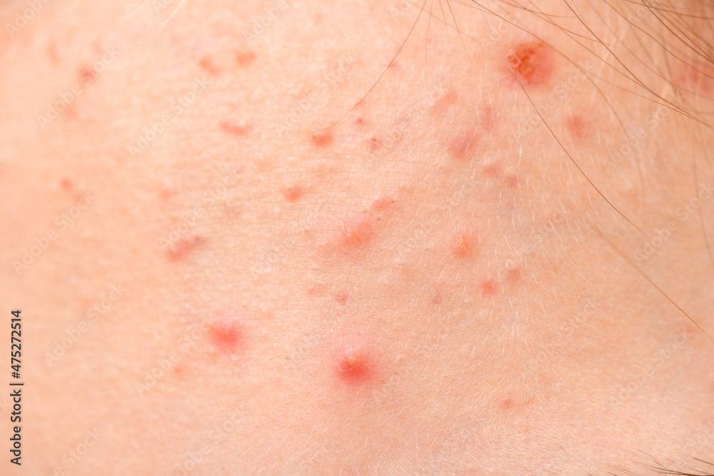 face of a teenage girl with pimples, acne on the forehead skin, portrait