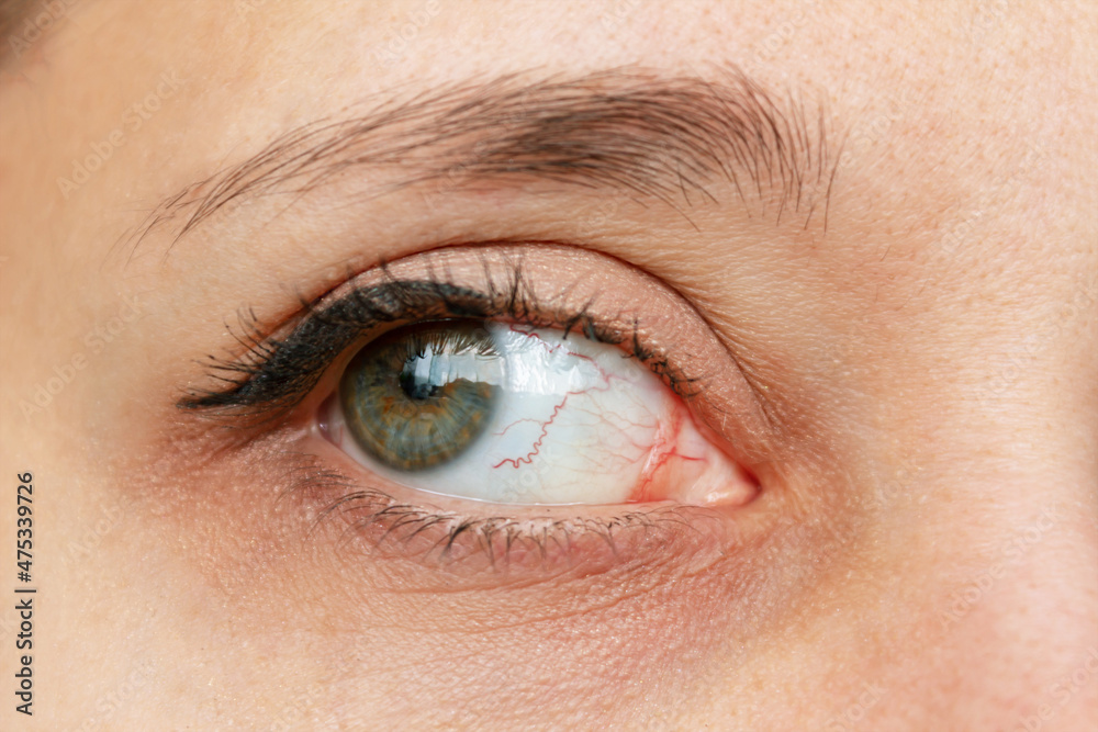 Fototapeta premium Close-up of female eye with red inflamed and dilated capillaries. Hemorrhage under the conjunctiva. Disease of retina of the eye. Conjunctivitis, keratitis, dry eye syndrome, trauma, uveitis