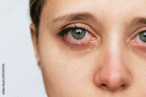 Cropped shot of a young caucasian crying woman with red eyes and nose. Depression, sadness, apathy, sorrow