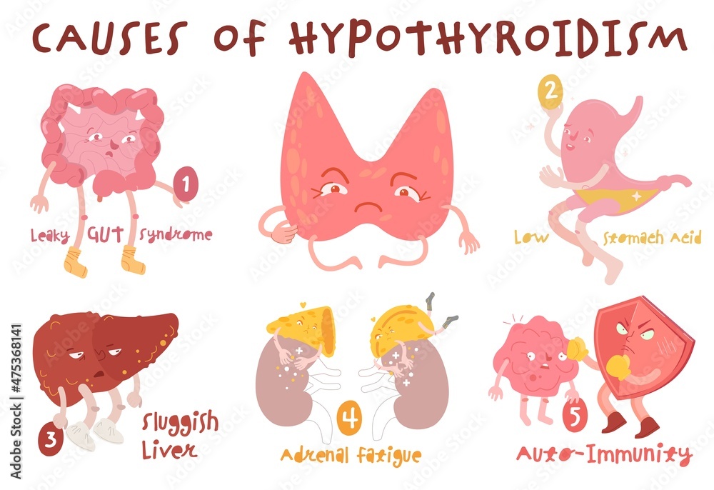 Causes Of Hypothyroidism Thyroid Gland Disease Endocrine System Disorder Medical Vector