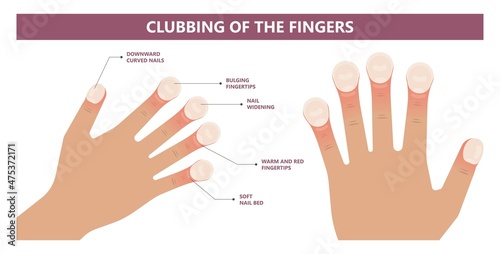 Nail clubbing. Symptoms tetralogy of Fallot bone swelling warning sign toenails coughing enlarged cyanosis late fingertips problem liver toe skin watch glass ild ipf pain copd photo