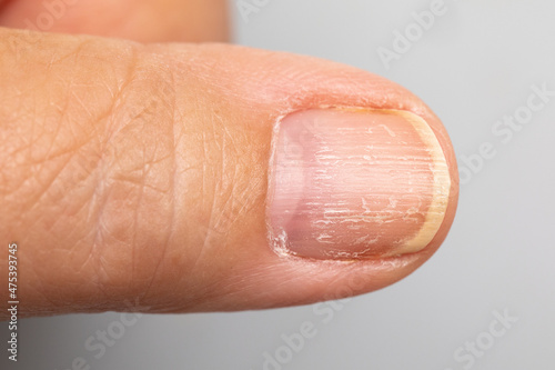 Dry damaged yellow finger nail macro view