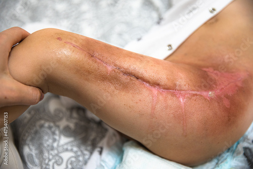 Burned area on the leg following radiotherapy  surgery to remove the cancerous tumor