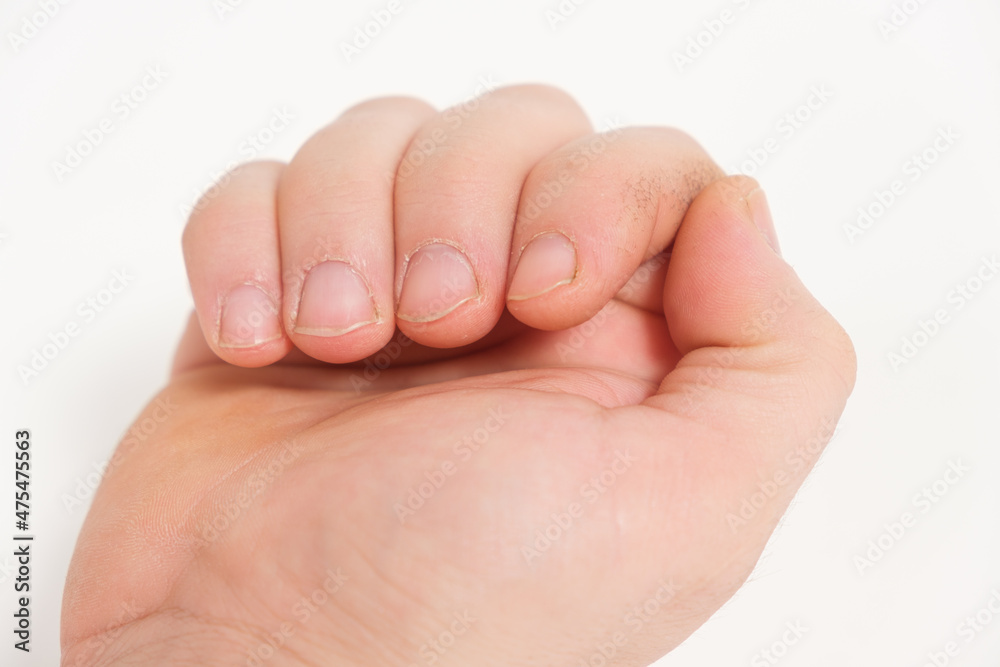 Unkempt male nails with a regrown cuticle on a white background Unkempt male nails with a regrown cuticle on a white background