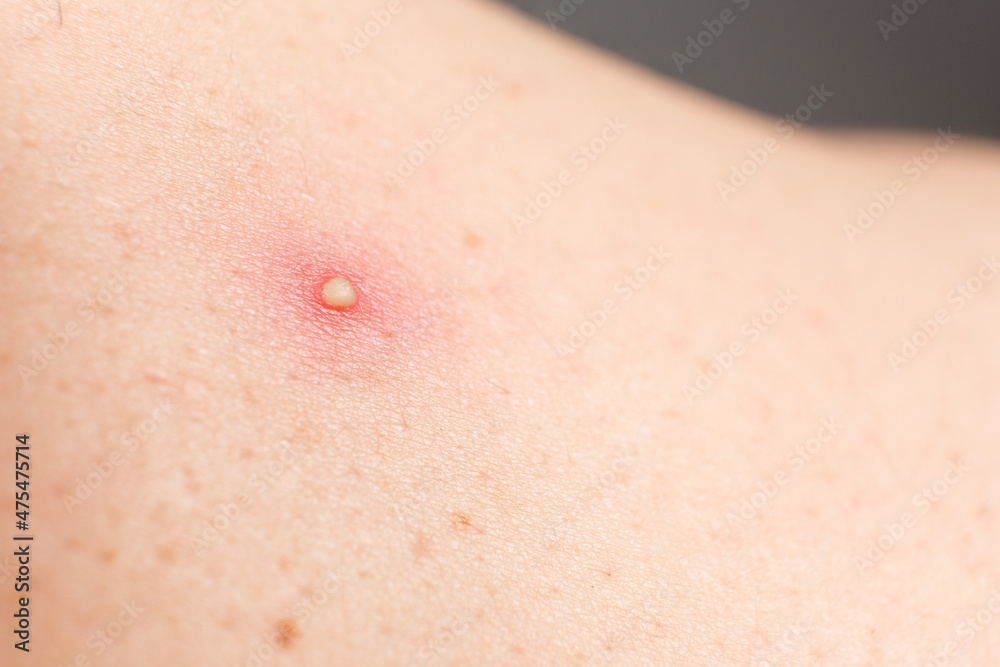 Pimple on the human body, skin problems.