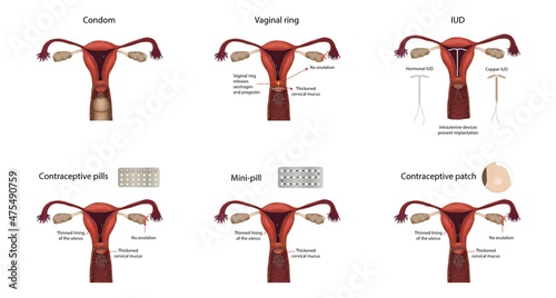 Contraception methods, illustration photo