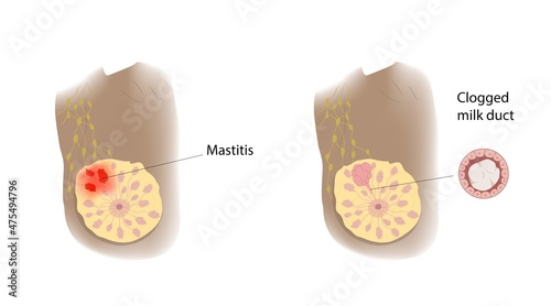 Mastitis and clogged milk duct comparison, illustration