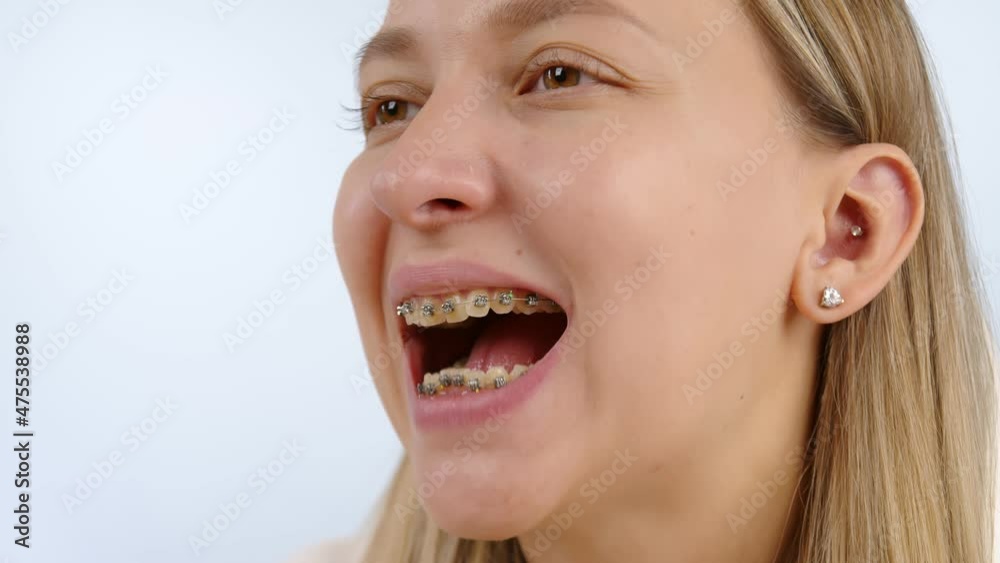 Young woman in braces at the appointment with the orthodontist. The girl with dental braces opens her mouth. Young woman in braces at the appointment with the orthodontist. The girl with dental braces opens her mouth.