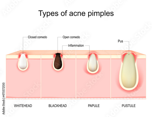 Photographie Types of acne pimples. Cross section of human Skin