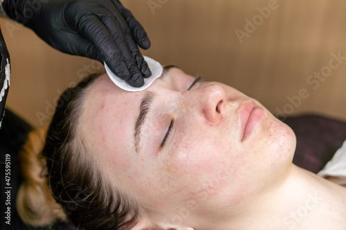 Cleansing the face with a cotton sponge after a cosmetic procedure.
