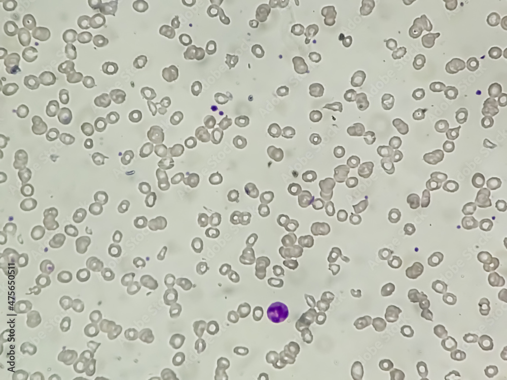 Dimorphic anemia analyzed by microscope. It is also called iron