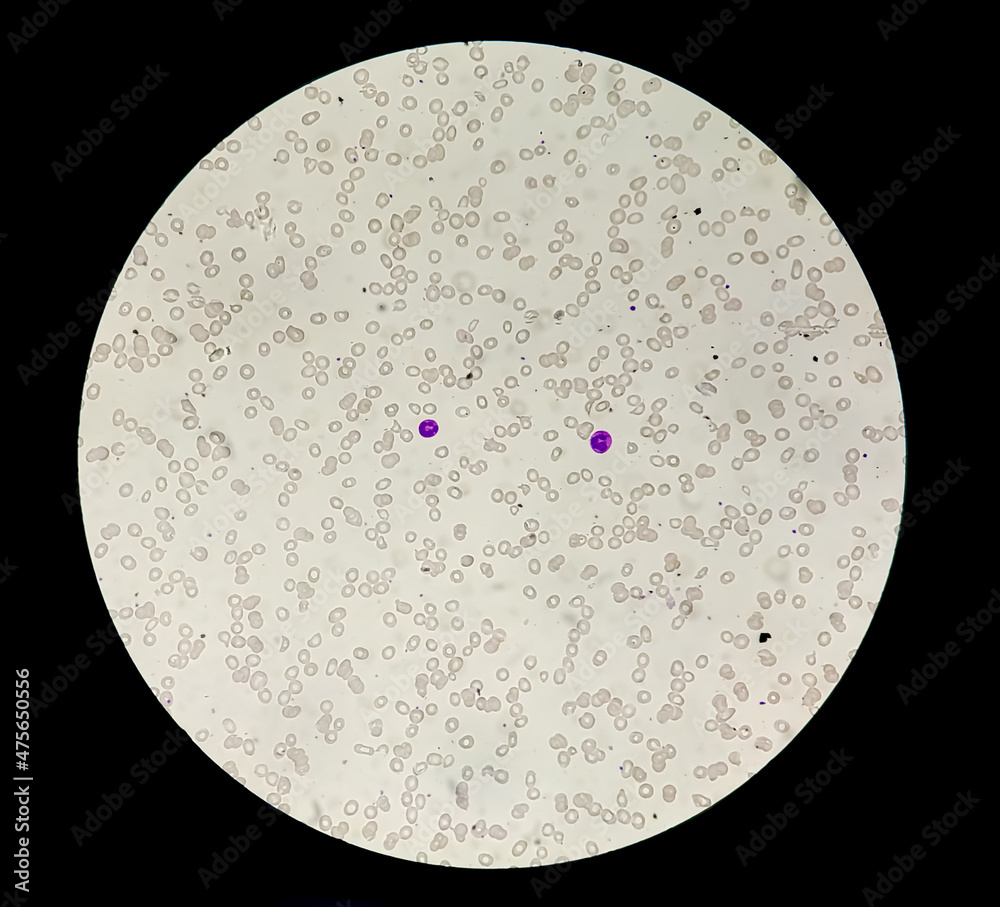 Dimorphic anemia analyzed by microscope. It is also called iron