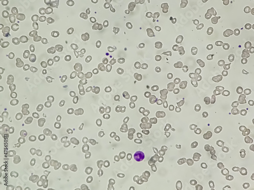 Dimorphic anemia analyzed by microscope. It is also called  iron- deficiency and macrocytic anemia. photo
