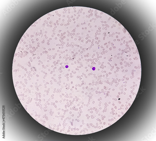 Dimorphic anemia analyzed by microscope. It is also called  iron- deficiency and macrocytic anemia. photo