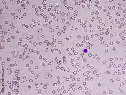 Macrocytic anemia with features of hemolysis and nucleated RBC analyzed by microscope.  photo