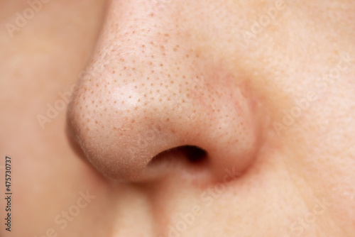 Close-up of a female nose with blackheads or black dots. Acne problem, comedones. Enlarged pores on the face. Cosmetology dermatology concept