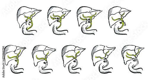 Strasberg-Bismuth Classification of iatrogenic bile duct injury