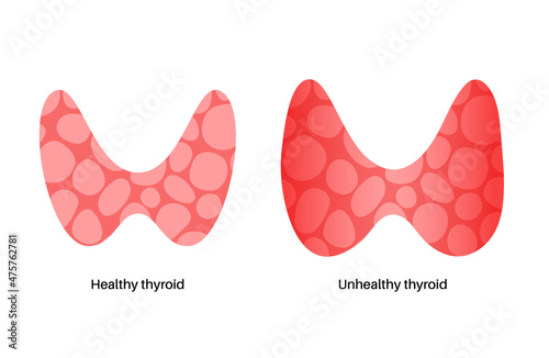 thyroid gland disease