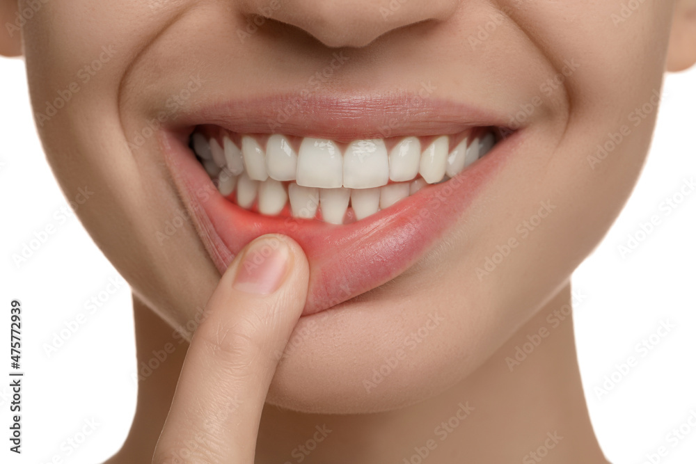 Young woman showing inflamed gums, closeup view Young woman showing inflamed gums, closeup view