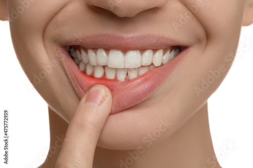Young woman showing inflamed gums  closeup view
