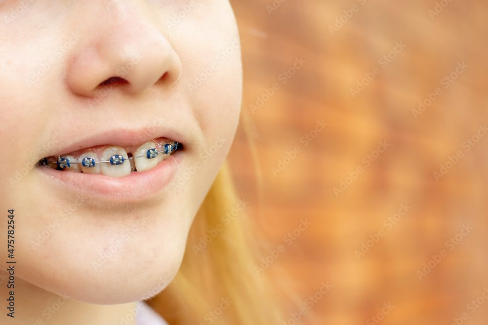 Close up of a teenage girl wearing metal braces. Orthodontic dental braces teeth straighteners. Gap between front teeth Close up of a teenage girl wearing metal braces. Orthodontic dental braces teeth straighteners. Gap between front teeth