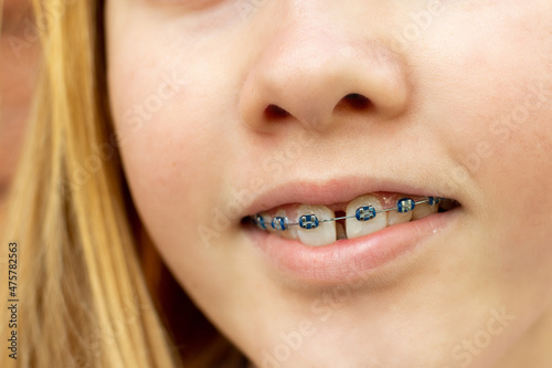 Close up of a teenage girl wearing metal braces. Orthodontic dental braces teeth straighteners. Gap between front teeth photo