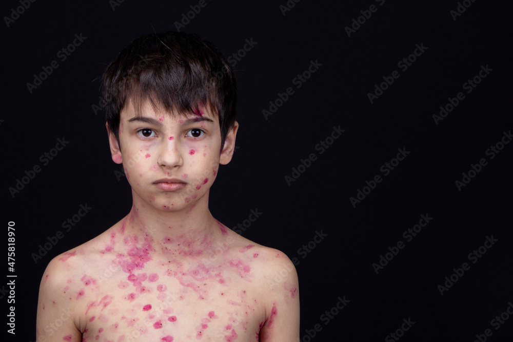 Chickenpox varicella scabies, sick child boy 8 years old with skin