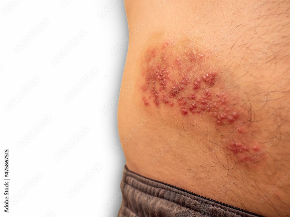 Shingles outbreak on torso. The varicella-zoster virus has formed a red rash with fluid-filled blisters on the belly. Shingles outbreak on torso. The varicella-zoster virus has formed a red rash with fluid-filled blisters on the belly.