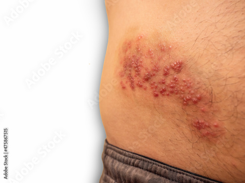 Shingles outbreak on torso. The varicella-zoster virus has formed a red rash with fluid-filled blisters on the belly. photo