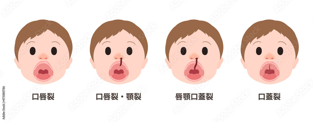 口唇口蓋裂 開口時の口唇裂 顎裂 口蓋裂のイラスト Stock ベクター Adobe Stock