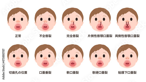 口唇口蓋裂のタイプのイラスト