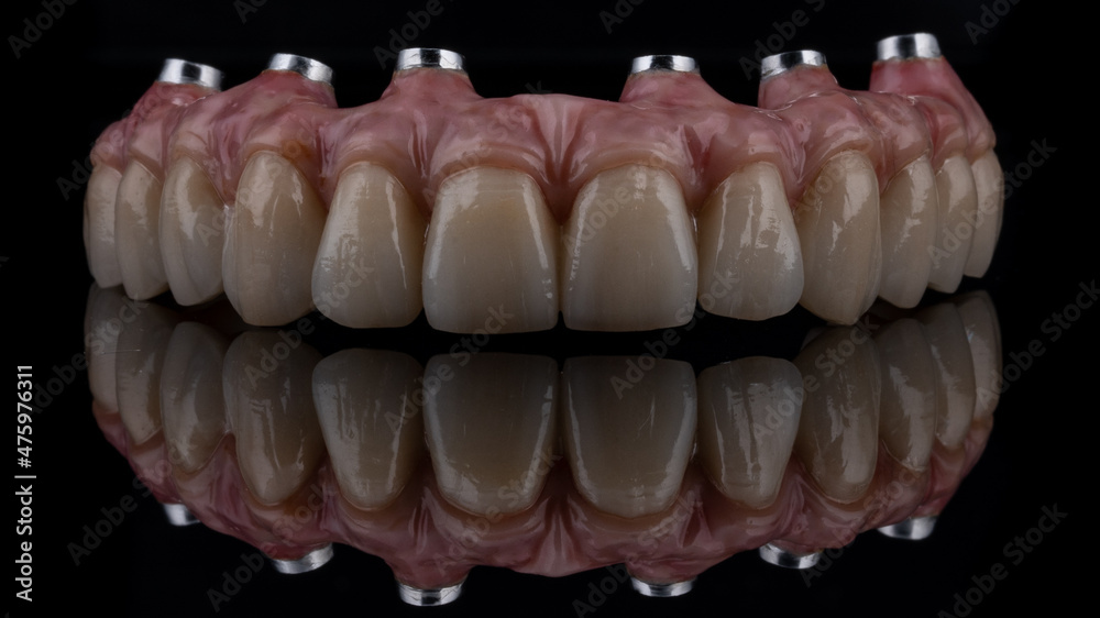 Dental implants and dentures in close-up Siemke on a black background
Dental implants and dentures in close-up Siemke on a black background